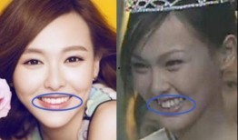 牙医爆料明星整牙视频,牙医亲述整牙全过程